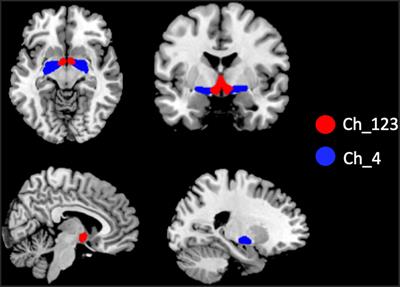 Distinct alterations of functional connectivity of the basal forebrain subregions in <mark class="highlighted">insomnia disorder</mark>